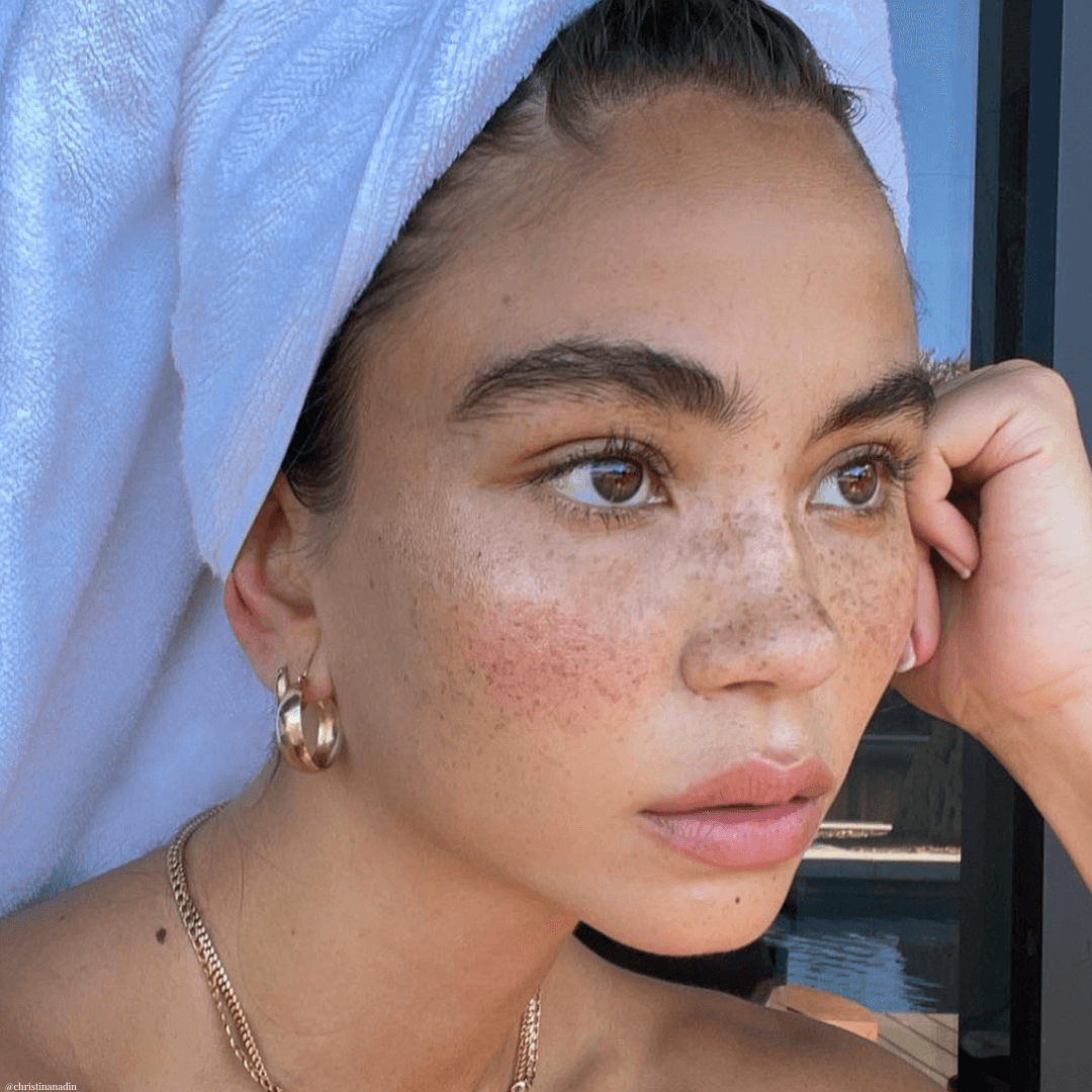 How To Deal With Hyperpigmentation (Aka Pregnancy Mask)
